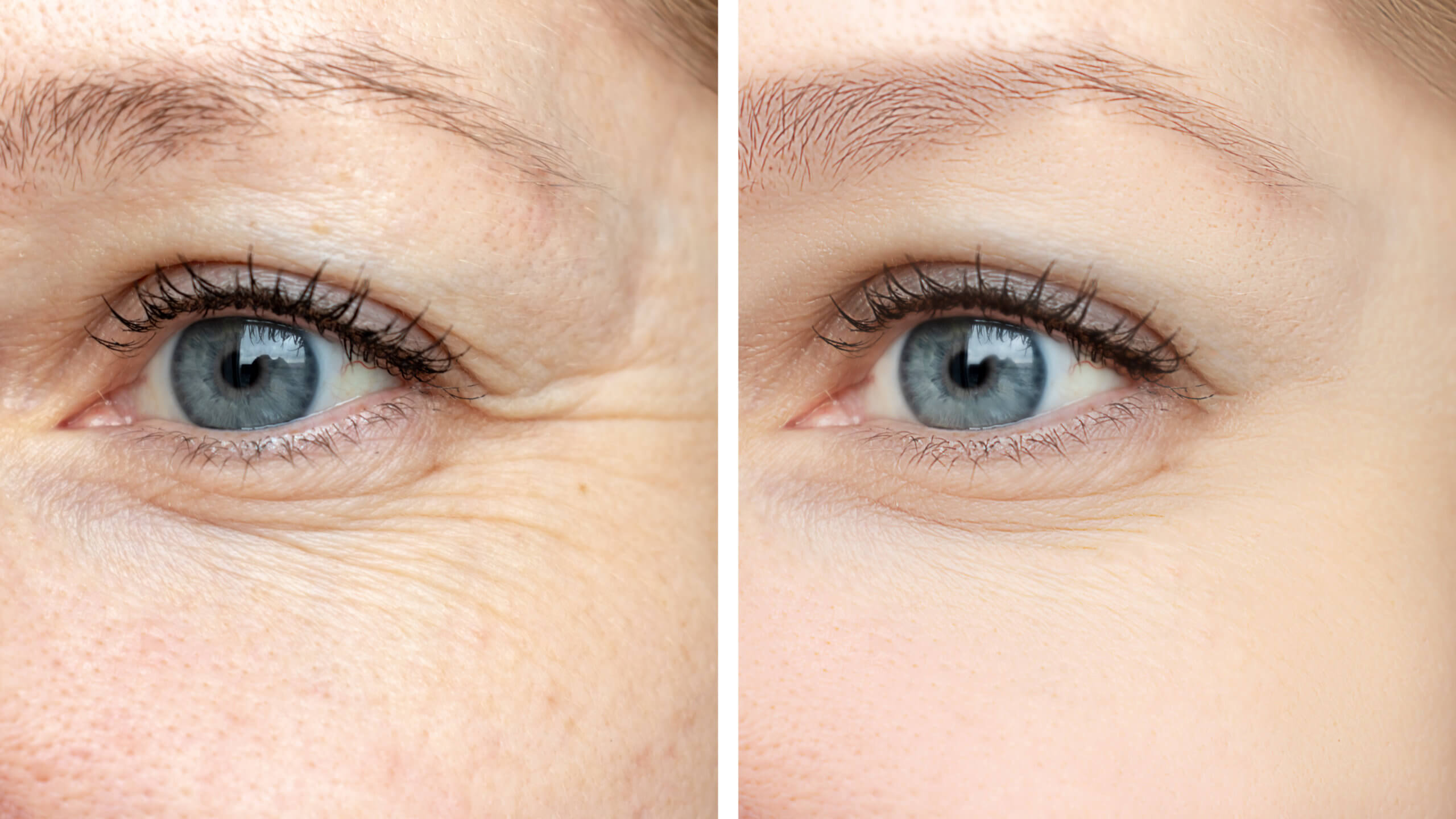 Woman face, eye wrinkles before and after treatment | Gig Harbor Aesthetics in Gig Harbor, WA