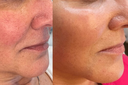 Before and After BBL + MOXI treatment results | Gig Harbor Aesthetics | Gig Harbor, WA