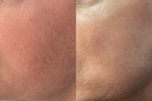 Before and After BBL + MOXI treatment results | Gig Harbor Aesthetics | Gig Harbor, WA
