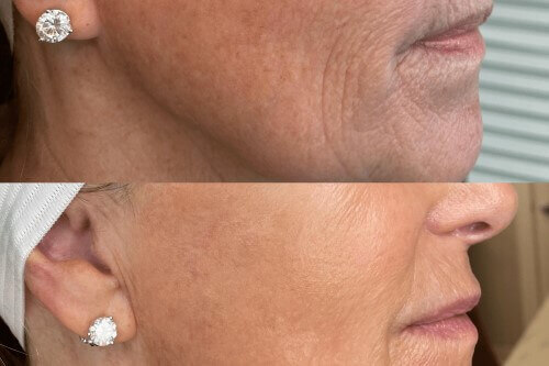 Before and After fillers treatment results | Gig Harbor Aesthetics | Gig Harbor, WA