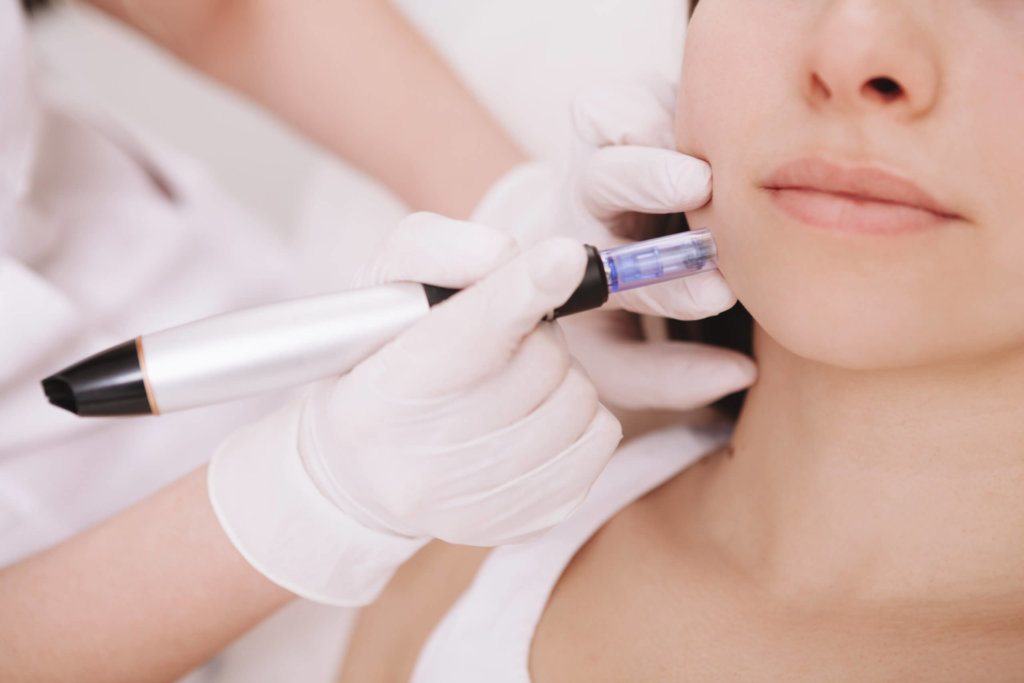 How Effective Is RF Microneedling Treatment by Gig Harbor Aesthetics