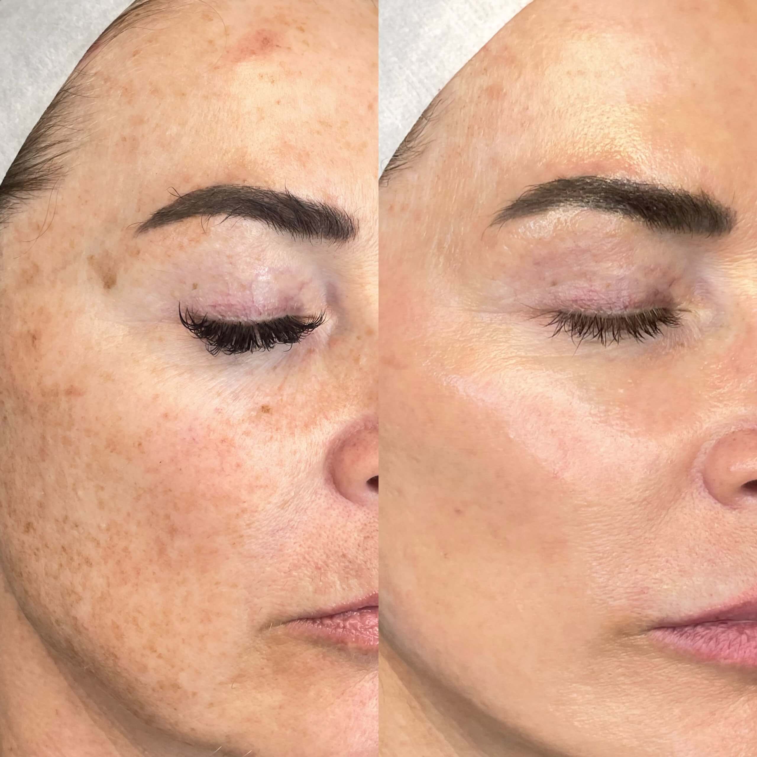 Laser Skin Treatments | BBL Photofacial and Moxi - Results Before Treatment Photos | Gig Harbor Aesthetics in Gig Harbor, WA