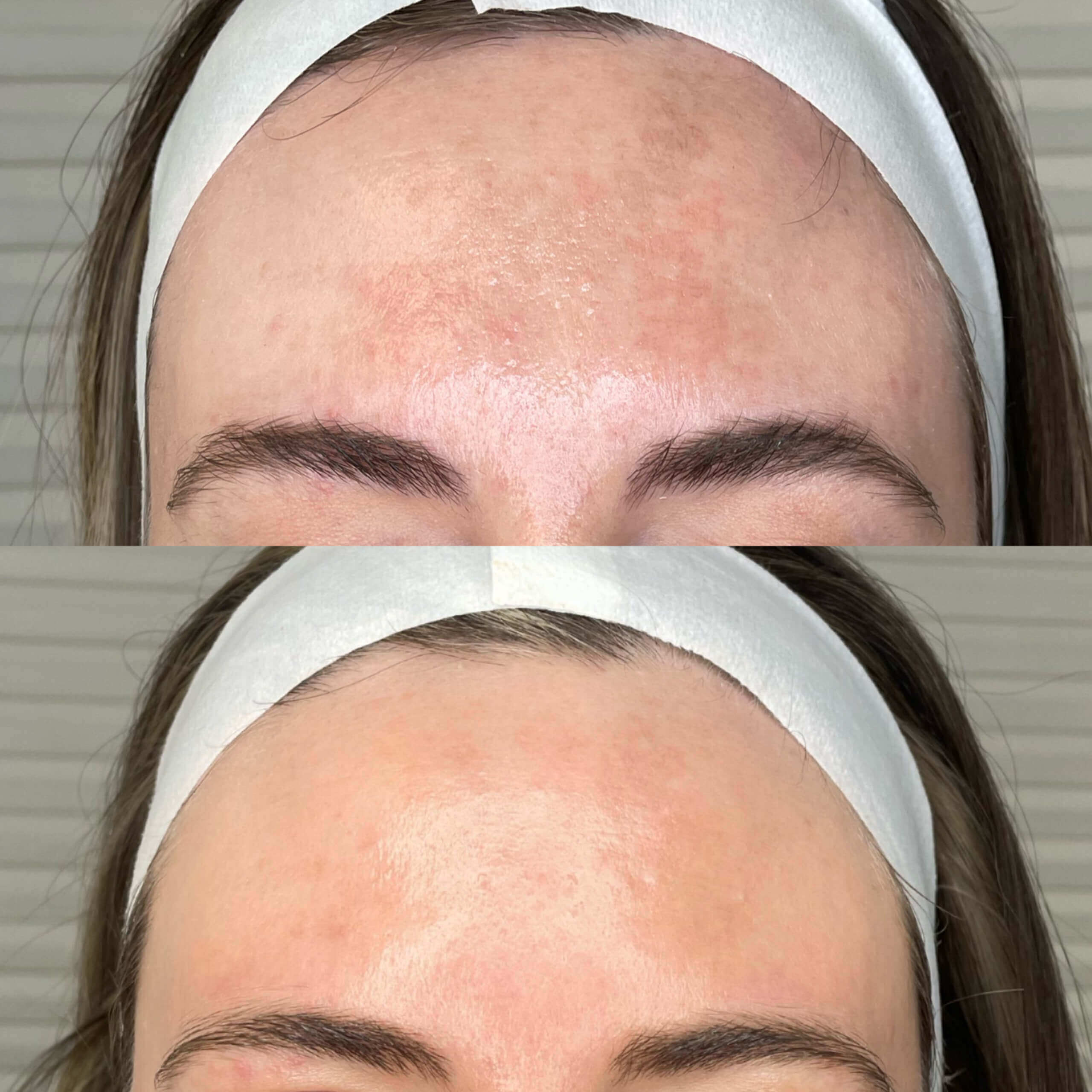 Young Female Getting bbl + moxi laser treatment before and after | Gig Harbor Aesthetics in Gig Harbor, WA