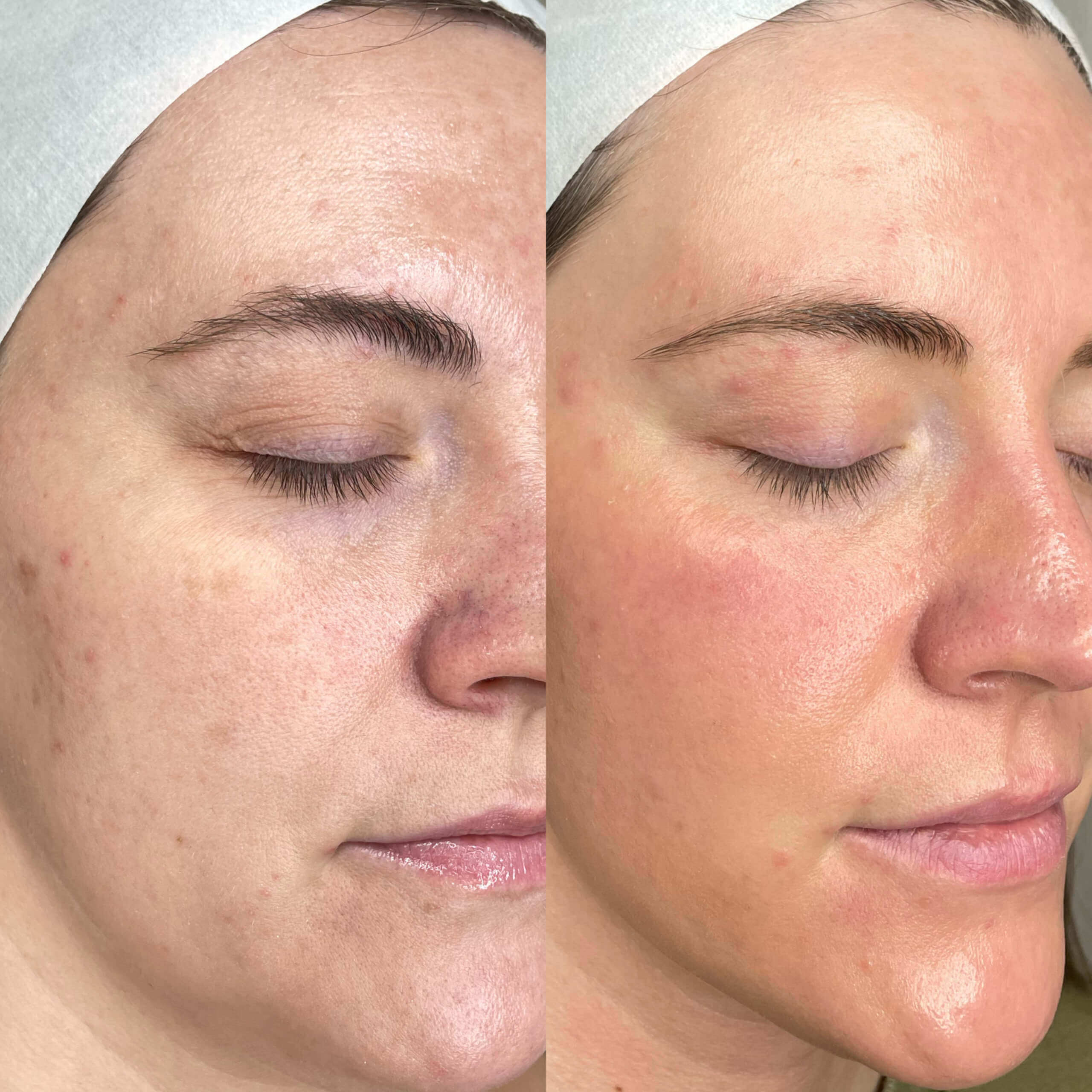 Young Female Getting bbl + moxi laser treatment before and after | Gig Harbor Aesthetics in Gig Harbor, WA