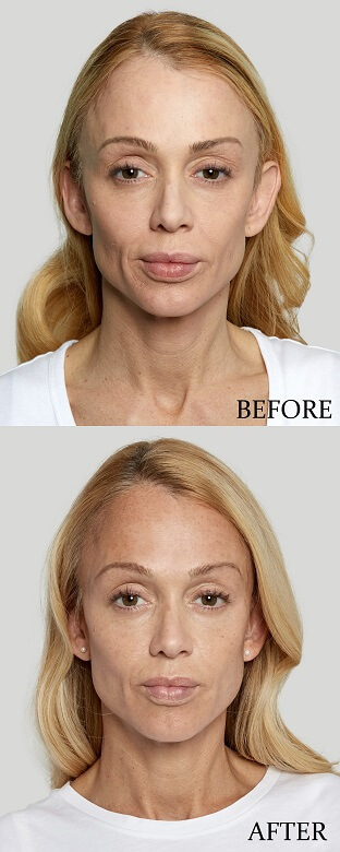 Sculptra Results Before & After Treatment Photos | Gig Harbor Aesthetics in Gig Harbor, WA