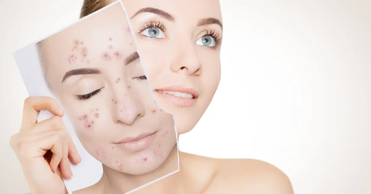Women taking acne treatment using Forever BBL in Gig Harbor , WA