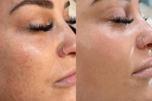 BBL-Diamond-Glow-Custom-Skincare-Routine At Gig Harbor Aesthetics | Gig Harbor WA