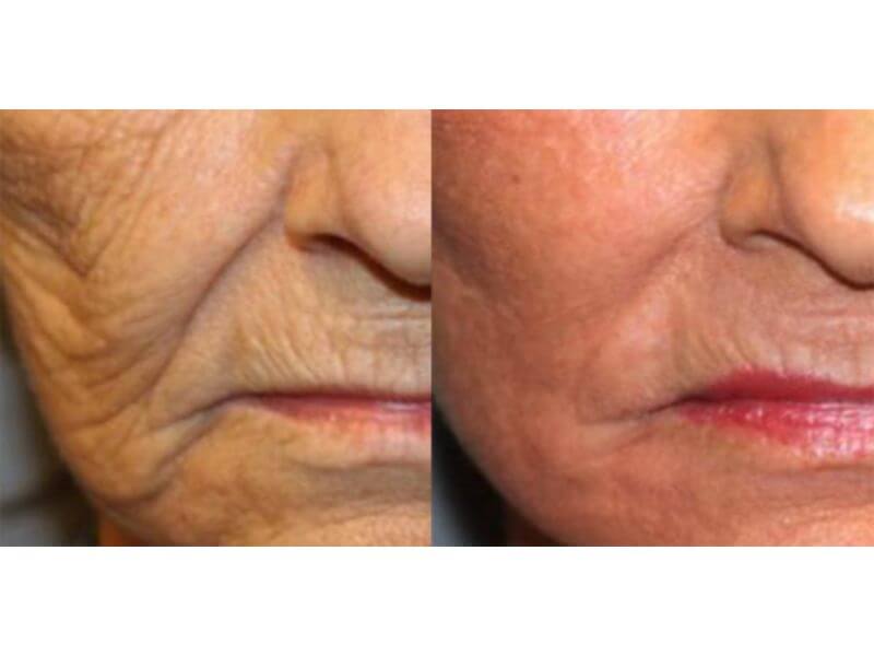 Scarlet-RF-Before-and-After-Wrinkles by | Gig Harbor Aesthetics |